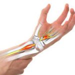 Carpal-Tunnel-Syndrome
