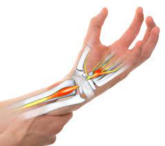 Carpal-Tunnel-Syndrome