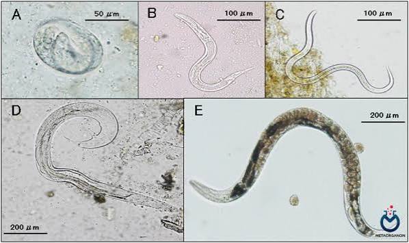 Strongyloidiasis (استرونژیلوئیدیازیس) در ایران